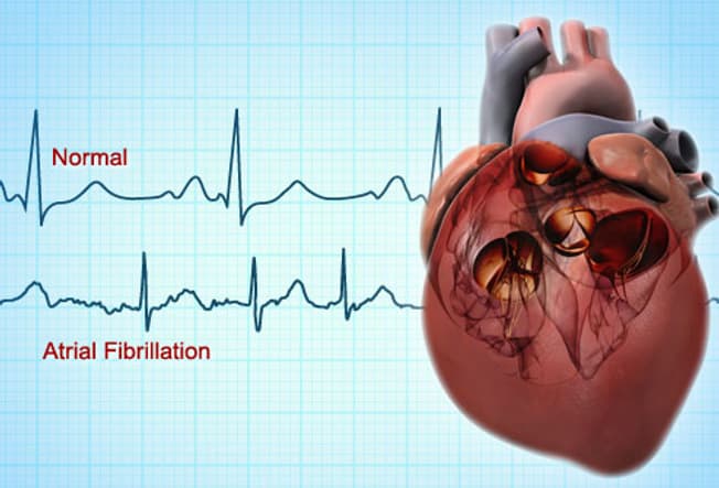Heart Dysfunction: Warning Signs Of Atrial Fibrillation, Greater Risk Of Stroke